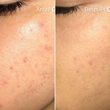 Sérum Facial Niacid (Niacinamida)
